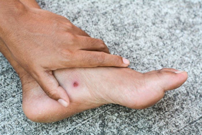 diabeto pėdų opų komplikacijos