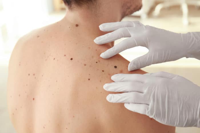 melanomos odos vėžys