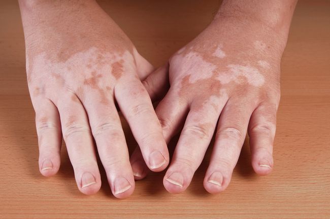 Vitiligo gali išgydyti