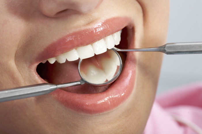 gydyti pūlingas ant dantenų