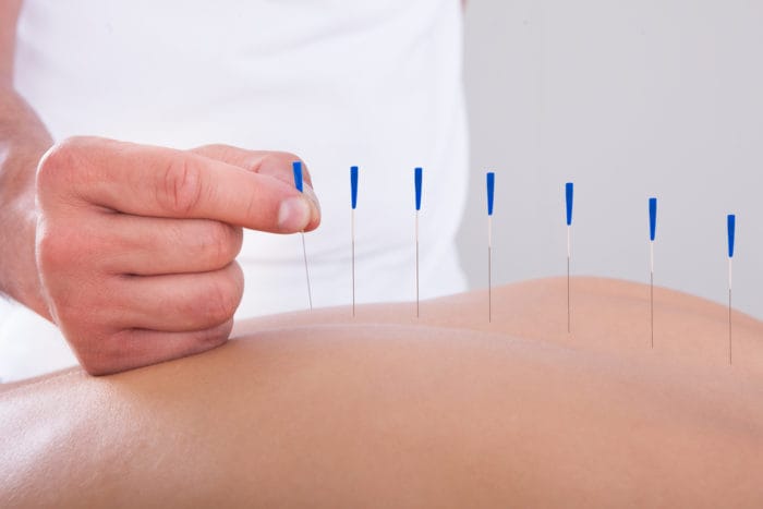 akupunktūra mažina skausmą
