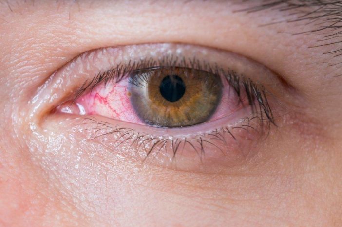 alerginis raudonųjų akių konjunktyvitas