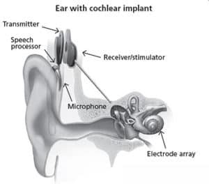cochlearinis implantas