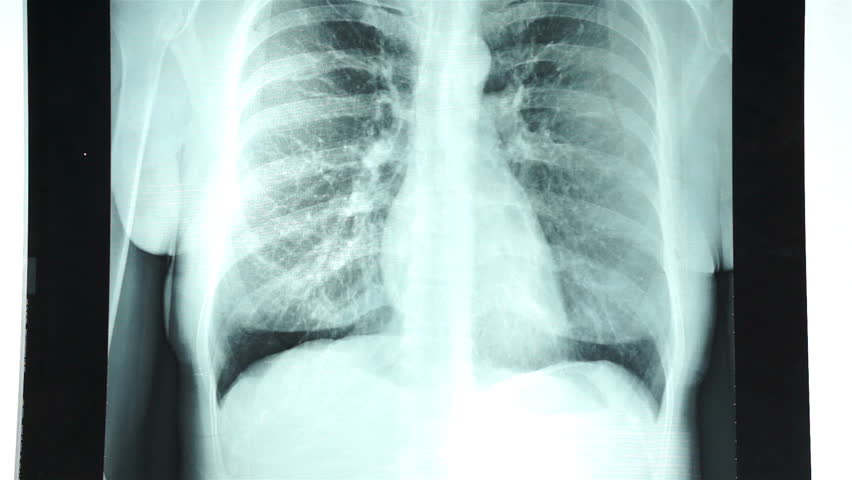 krūtinės ląstos rentgenograma
