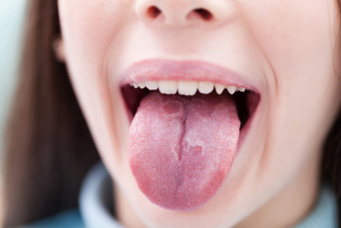 liežuvio psoriazė