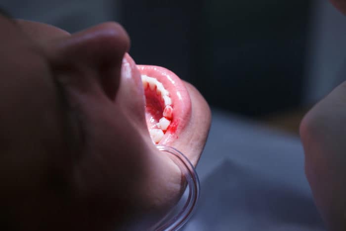 kraujavimo dantenų priežastis