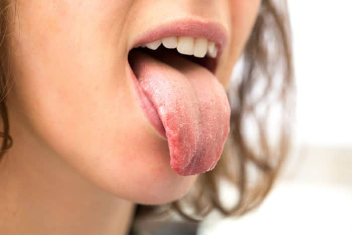 liežuvio niežėjimo priežastis