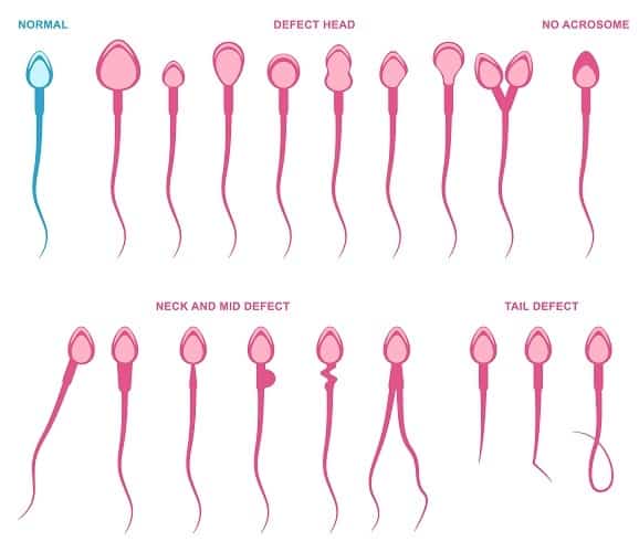 spermos sutrikimai